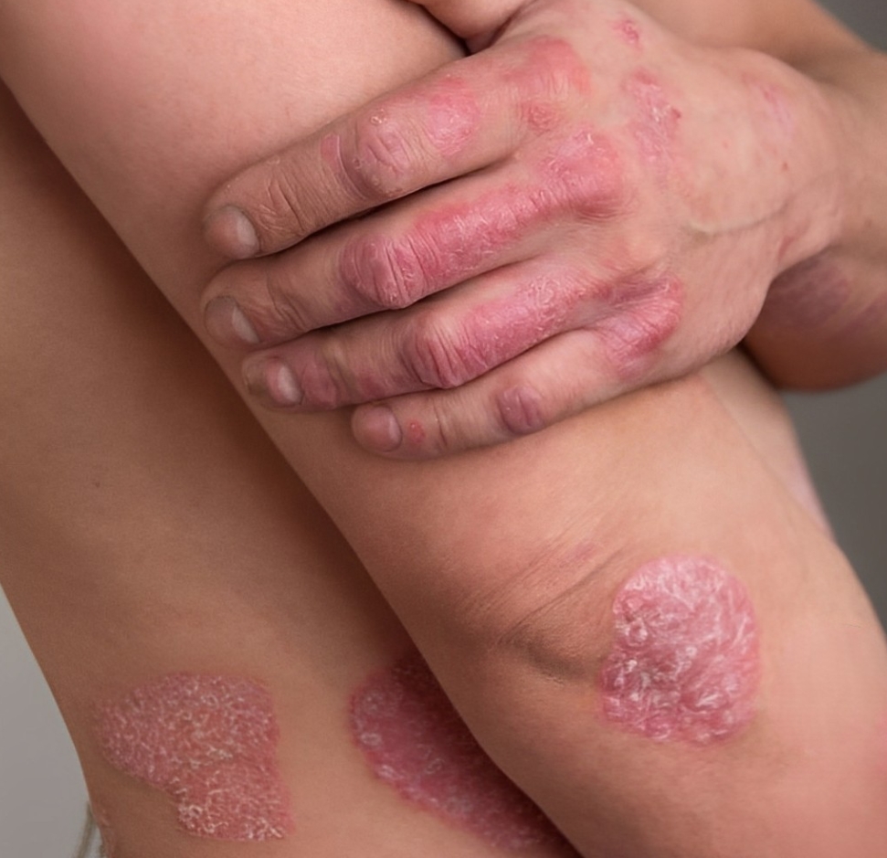 Psoriasis
