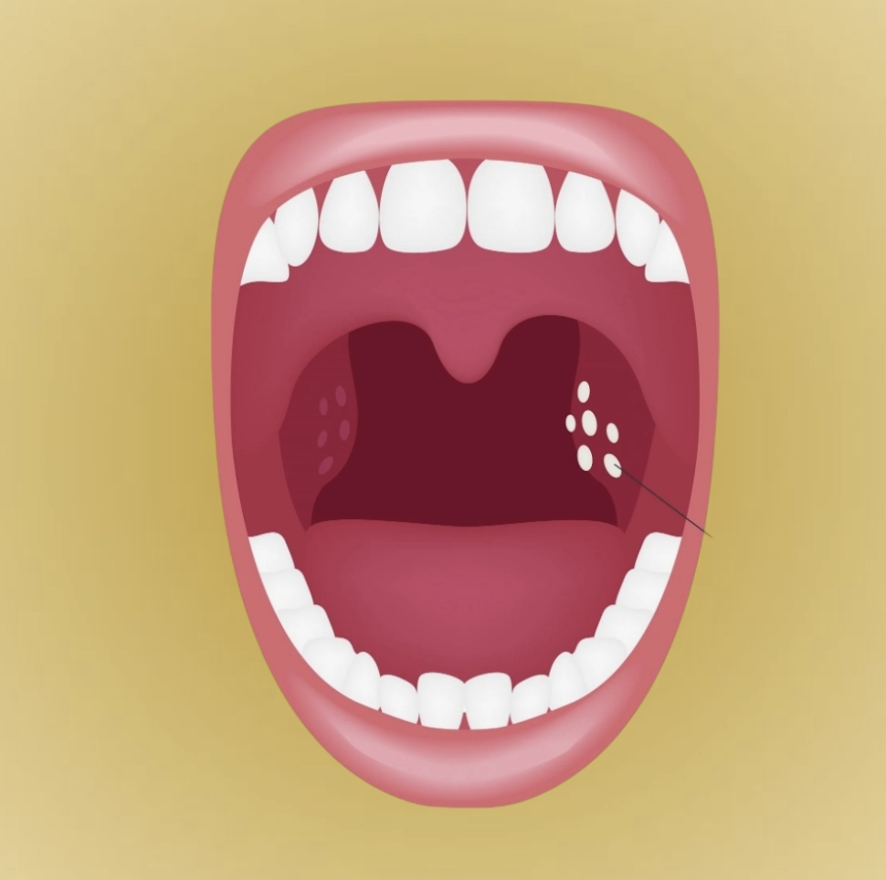 Tonsilitis