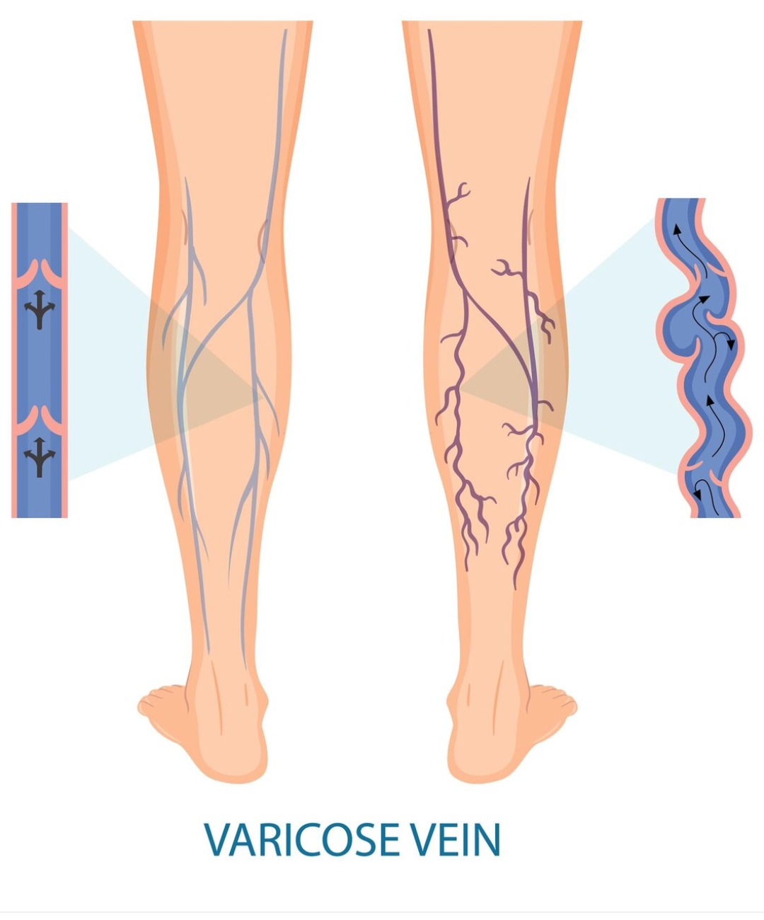 Varicose Vein