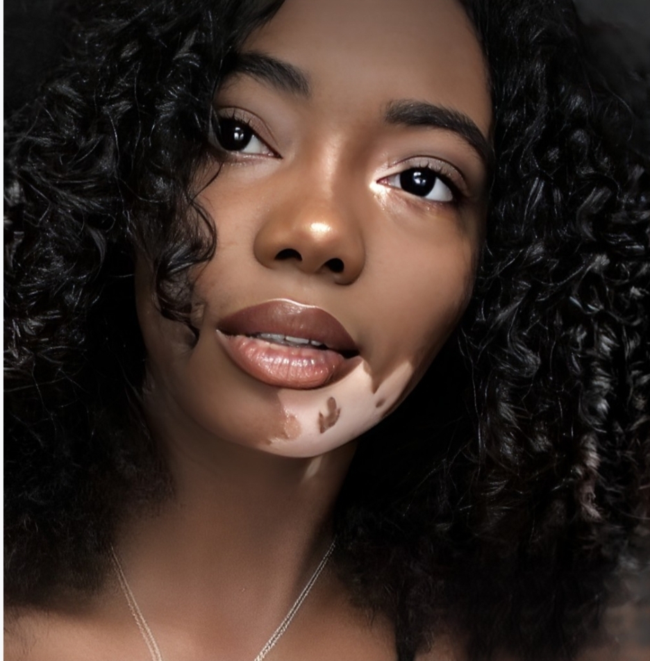 Vitiligo