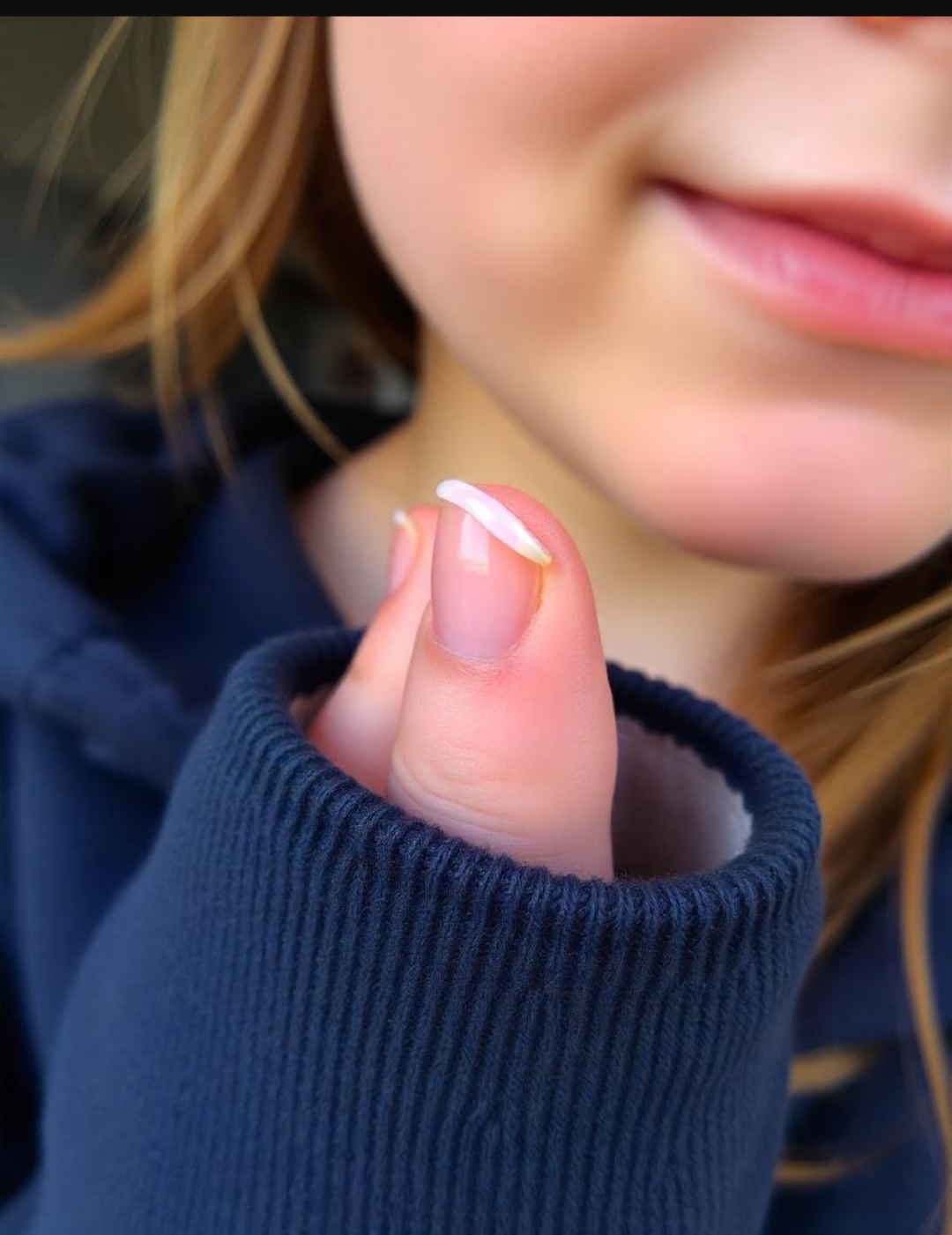 Brittle nail